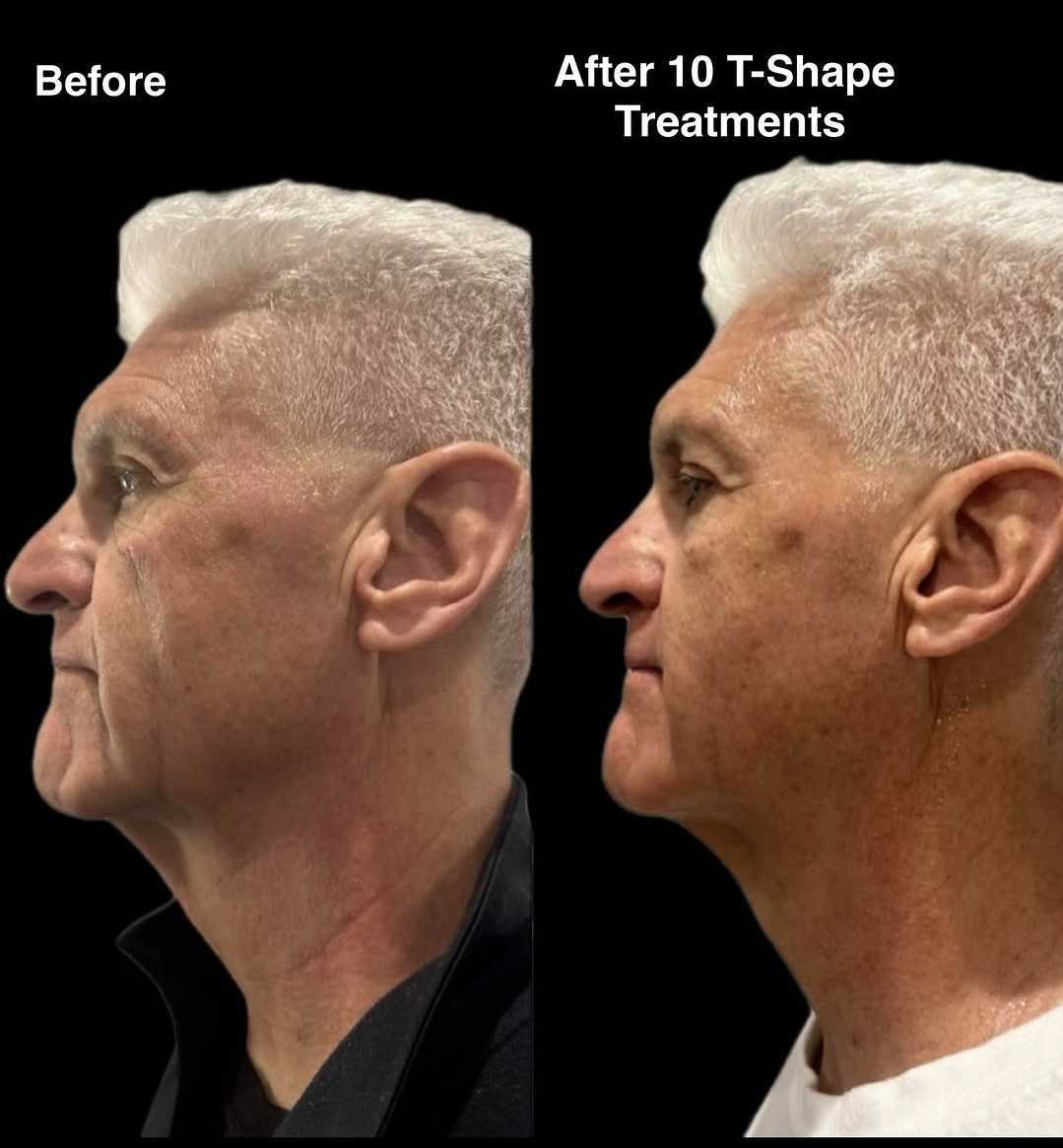 T-Shape 2 before and after results — Jawline & Neck