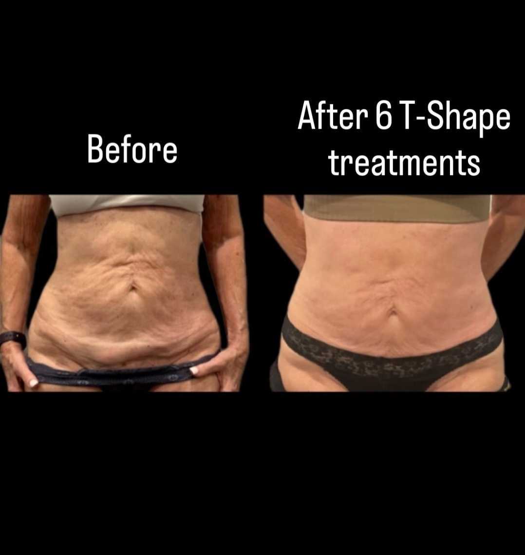 T-Shape 2 before and after results — Abdomen
