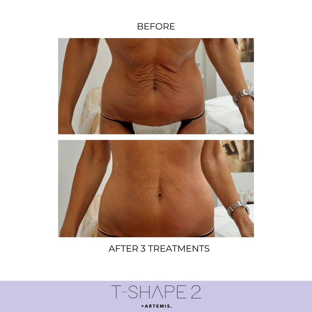 T-Shape 2 before and after results — Abdomen