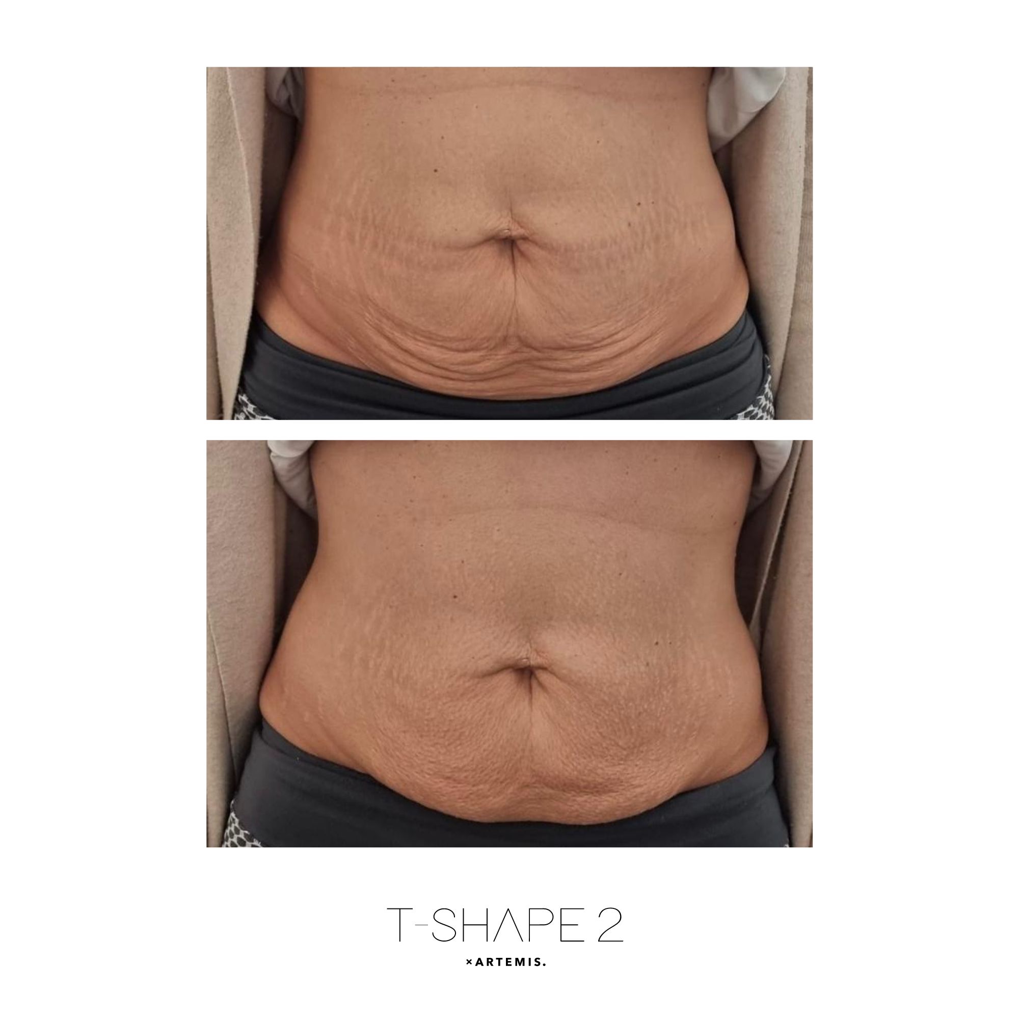 T-Shape 2 before and after results — Abs