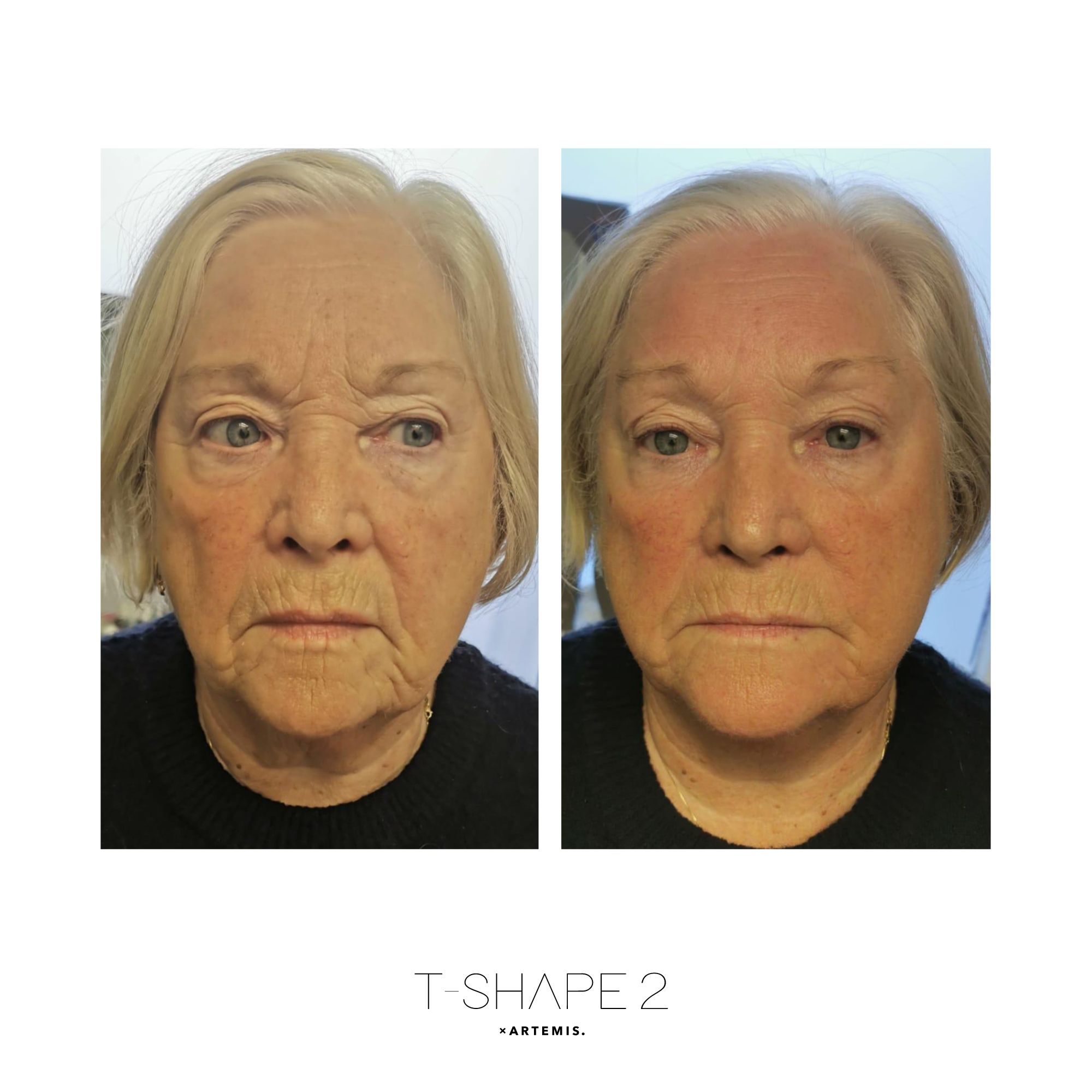 T-Shape 2 before and after results — Face