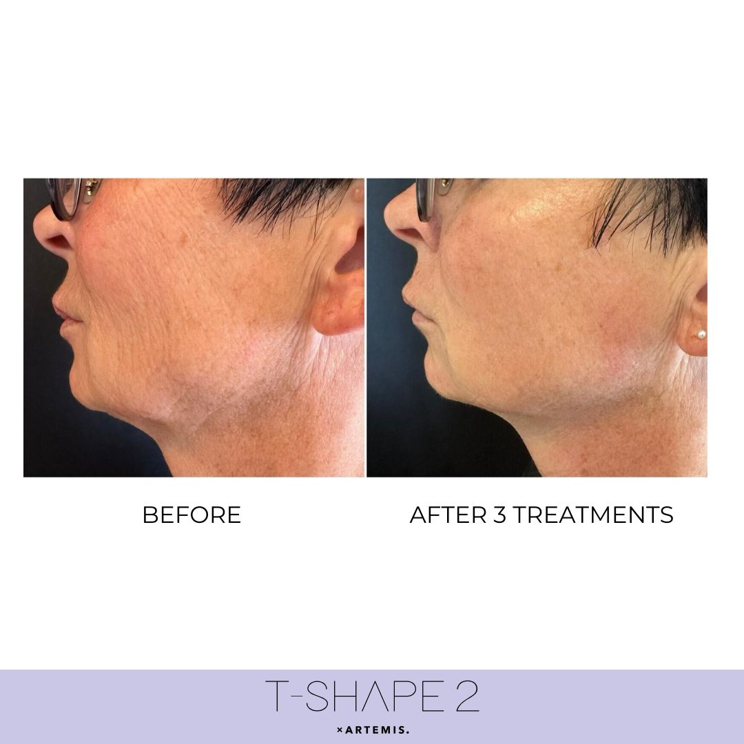 T-Shape 2 before and after results — Neck